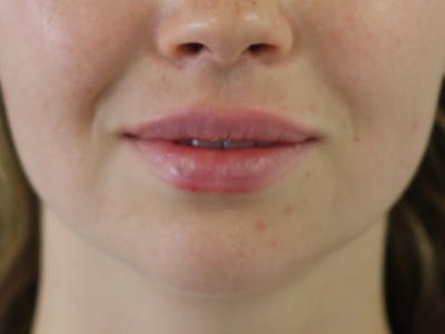Filler Before & After Gallery - Patient 294241 - Image 2