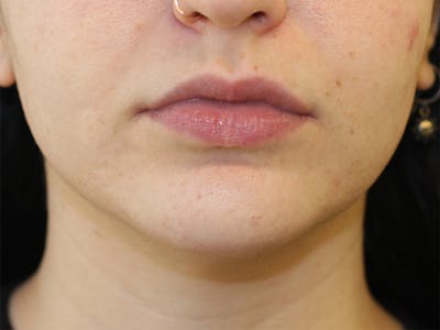 Filler Before & After Gallery - Patient 413568 - Image 1