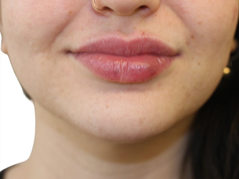 Filler Before & After Gallery - Patient 413568 - Image 2