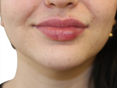 Filler Before & After Gallery - Patient 413568 - Image 2