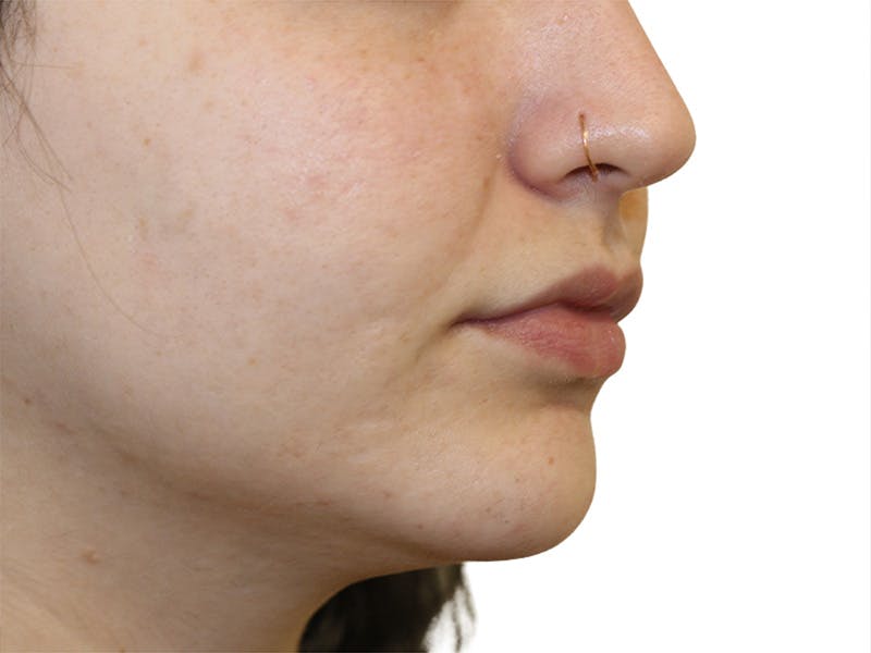 Filler Before & After Gallery - Patient 413568 - Image 3