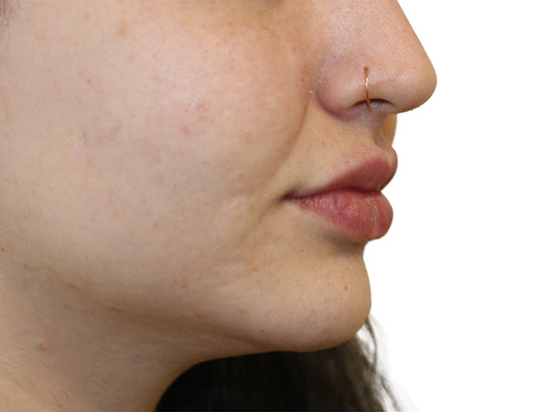 Filler Before & After Gallery - Patient 413568 - Image 4