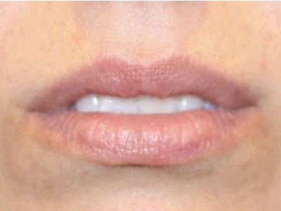 Filler Before & After Gallery - Patient 307192 - Image 1