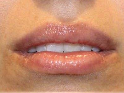 Filler Before & After Gallery - Patient 307192 - Image 2