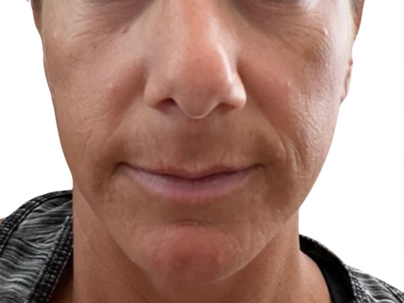 Filler Before & After Gallery - Patient 244774 - Image 1