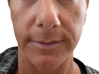Filler Before & After Gallery - Patient 244774 - Image 1