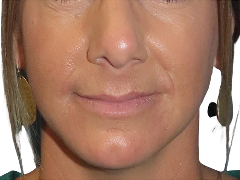 Filler Before & After Gallery - Patient 244774 - Image 2