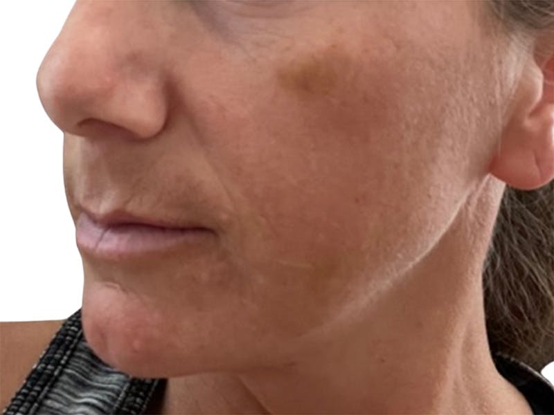 Filler Before & After Gallery - Patient 244774 - Image 3