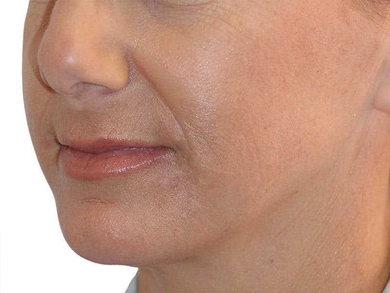 Filler Before & After Gallery - Patient 244774 - Image 4