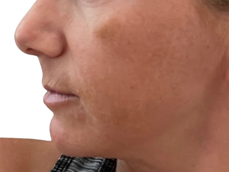 Filler Before & After Gallery - Patient 244774 - Image 5