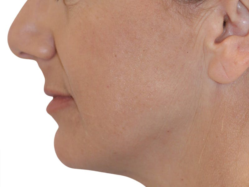 Filler Before & After Gallery - Patient 244774 - Image 6