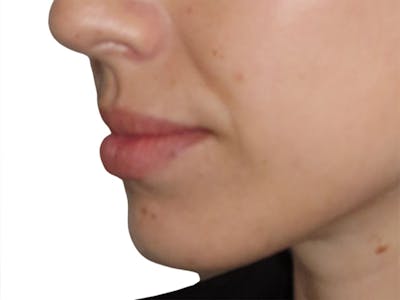 Filler Before & After Gallery - Patient 863446 - Image 1