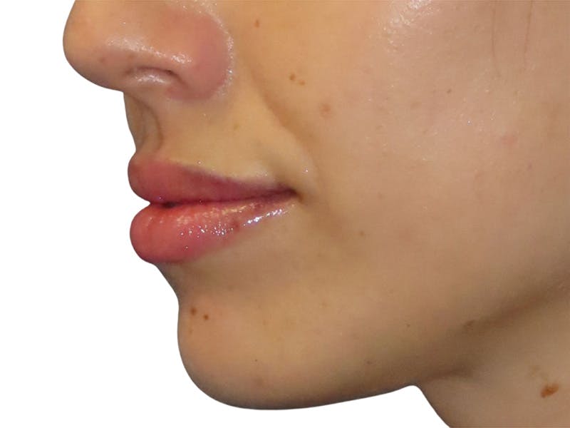 Filler Before & After Gallery - Patient 863446 - Image 2
