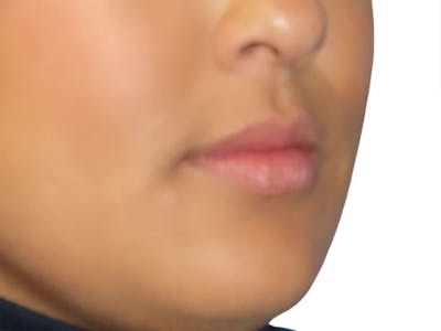 Filler Before & After Gallery - Patient 812566 - Image 1