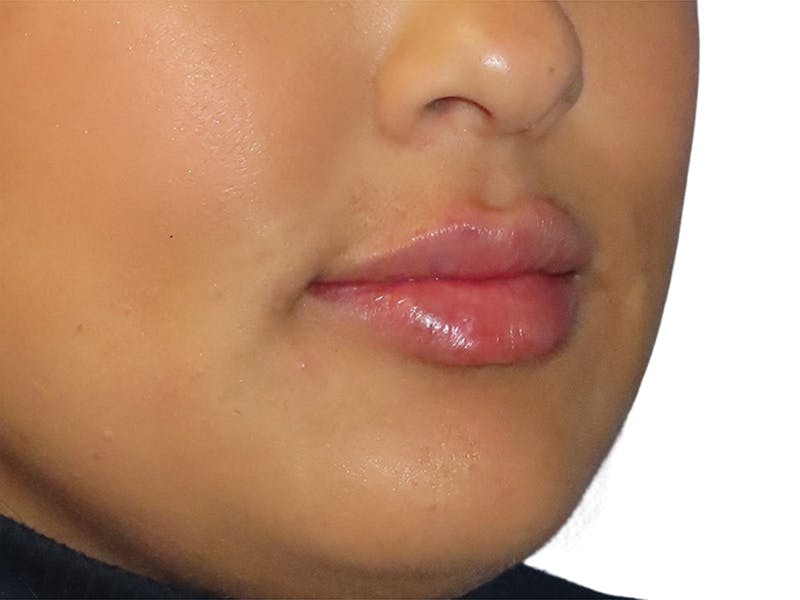 Filler Before & After Gallery - Patient 812566 - Image 2