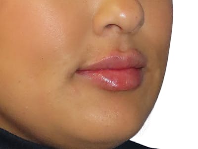 Filler Before & After Gallery - Patient 812566 - Image 2