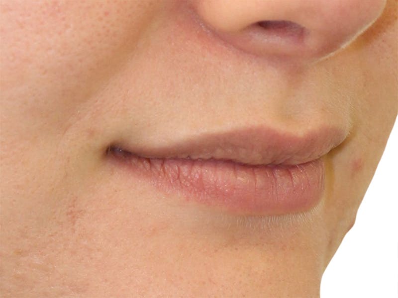 Filler Before & After Gallery - Patient 169834 - Image 1