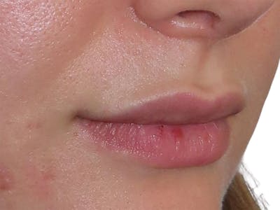 Filler Before & After Gallery - Patient 169834 - Image 2