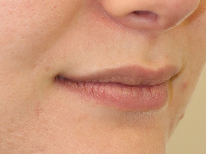 Filler Before & After Gallery - Patient 169834 - Image 3