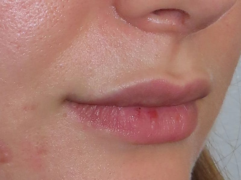 Filler Before & After Gallery - Patient 169834 - Image 4