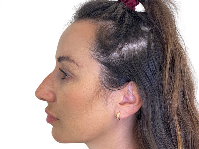 Filler Before & After Gallery - Patient 134084 - Image 1