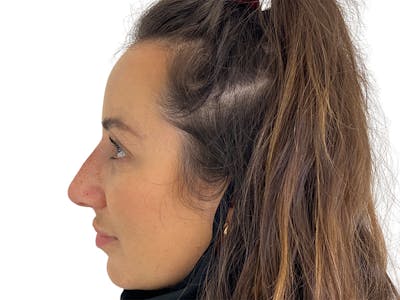 Filler Before & After Gallery - Patient 134084 - Image 2