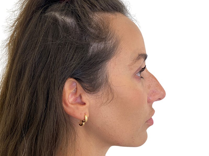 Filler Before & After Gallery - Patient 134084 - Image 3