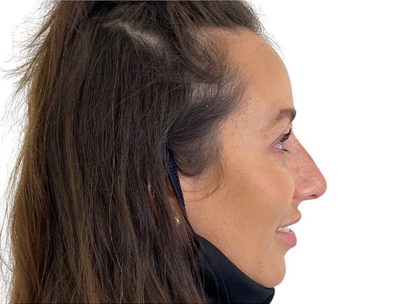 Filler Before & After Gallery - Patient 134084 - Image 4