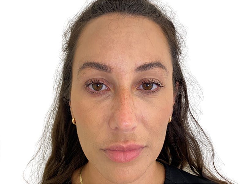 Filler Before & After Gallery - Patient 134084 - Image 5