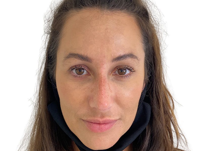 Filler Before & After Gallery - Patient 134084 - Image 6