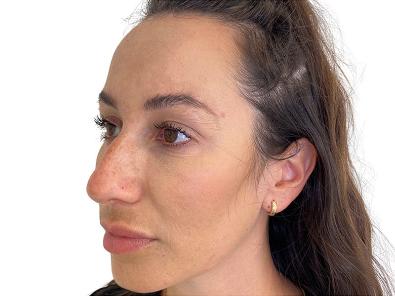 Filler Before & After Gallery - Patient 134084 - Image 7