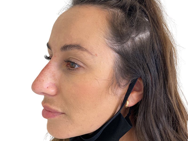 Filler Before & After Gallery - Patient 134084 - Image 8