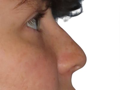 Filler Before & After Gallery - Patient 692983 - Image 1