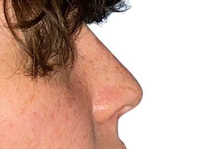 Filler Before & After Gallery - Patient 692983 - Image 2
