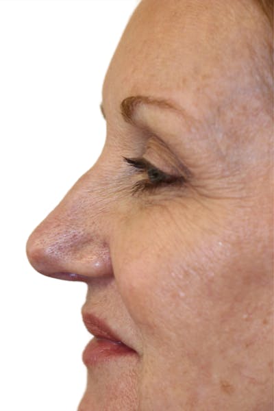 Filler Before & After Gallery - Patient 218226 - Image 1