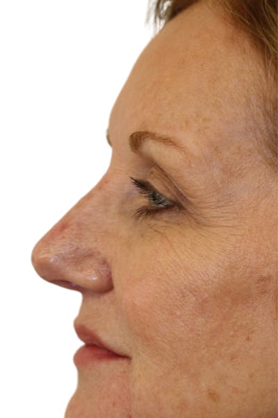 Filler Before & After Gallery - Patient 218226 - Image 2