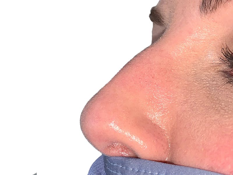 Filler Before & After Gallery - Patient 414502 - Image 1