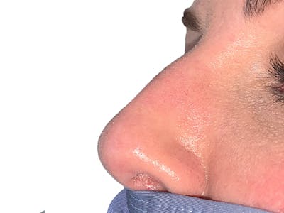 Filler Before & After Gallery - Patient 414502 - Image 1