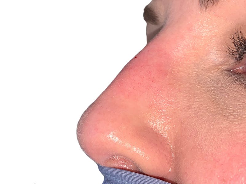 Filler Before & After Gallery - Patient 414502 - Image 2