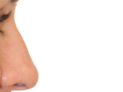 Filler Before & After Gallery - Patient 247871 - Image 1