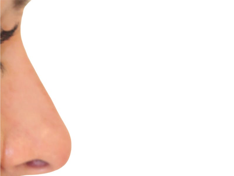 Filler Before & After Gallery - Patient 247871 - Image 2