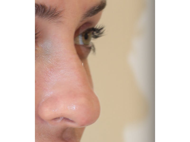 Filler Before & After Gallery - Patient 247871 - Image 3