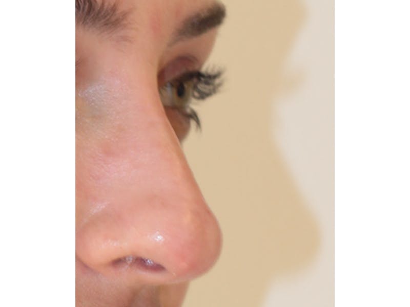 Filler Before & After Gallery - Patient 247871 - Image 4