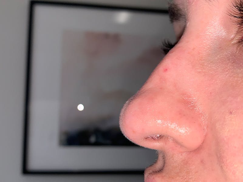 Filler Before & After Gallery - Patient 247871 - Image 5