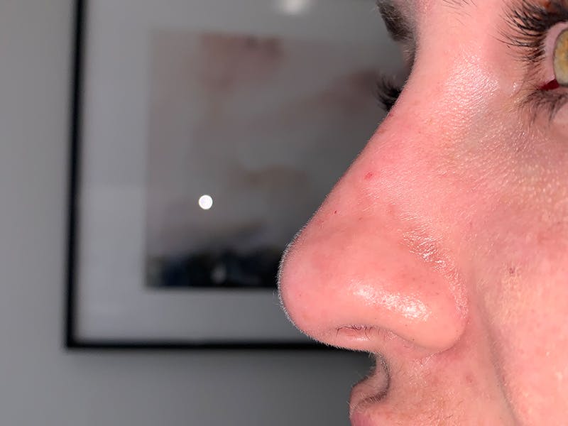 Filler Before & After Gallery - Patient 247871 - Image 6