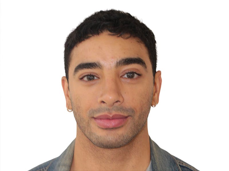 Filler Before & After Gallery - Patient 288013 - Image 1