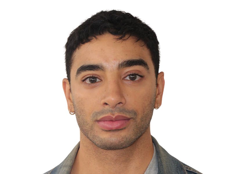 Filler Before & After Gallery - Patient 288013 - Image 2