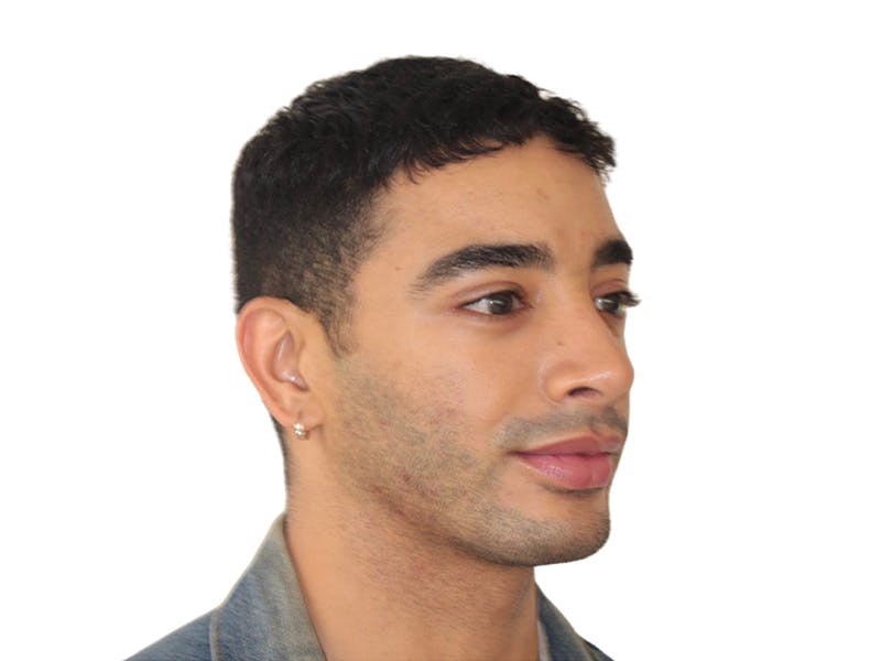 Filler Before & After Gallery - Patient 288013 - Image 3