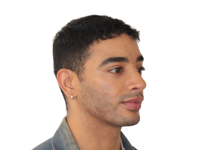 Filler Before & After Gallery - Patient 288013 - Image 4