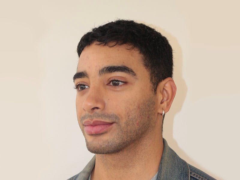 Filler Before & After Gallery - Patient 288013 - Image 5